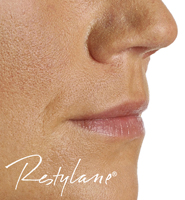http://www.discreetaesthetics.co.uk/Content/images/comparison/dermalfiller2before.jpg